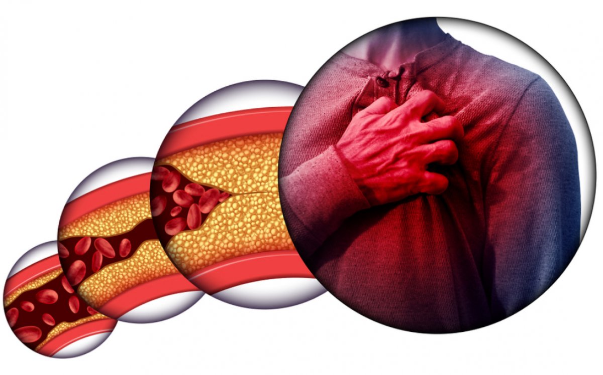 kolesterol_1711796047