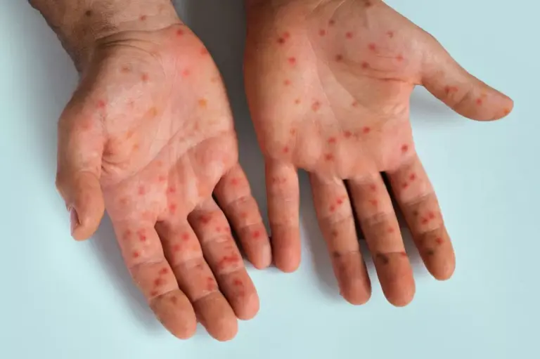 0_Human-Hands-with-Painful-Rash-Red-Spots-Blisters-on-the-Skin-Health-Problem-Monkeypox-Disease-Sym